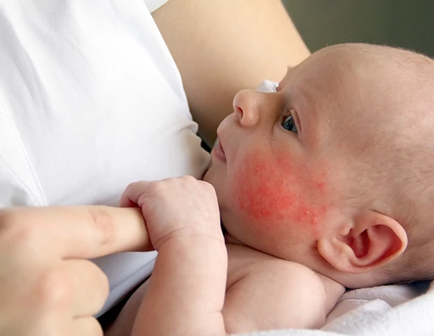 Criança com irritação na pele sendo segurada pela mãe
